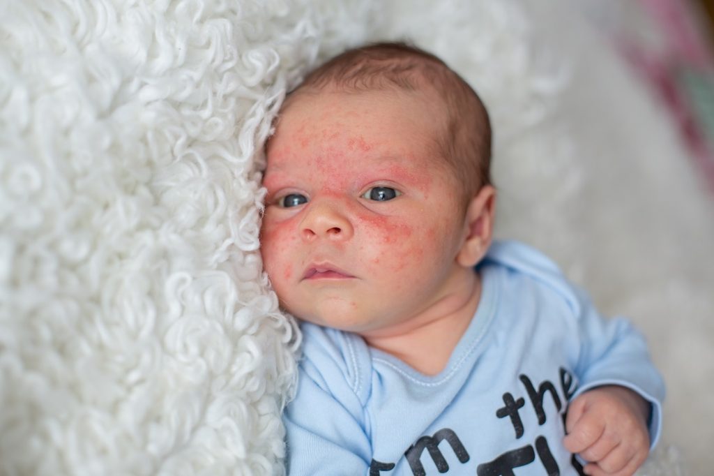 acne neonatale rimedi
