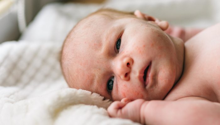Cos’è l’acne neonatale